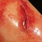 Product Image TrueClot® Wound Packing Task Trainer, Knife-Laceration Wound