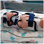 Product Image Papoose Infant Immobilizer